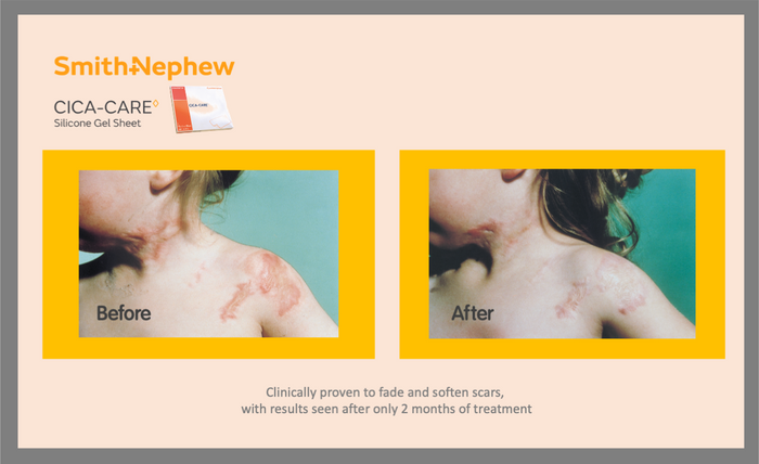 CICA-CARE Silicone Gel Sheet