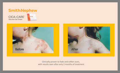 CICA-CARE Silicone Gel Sheet